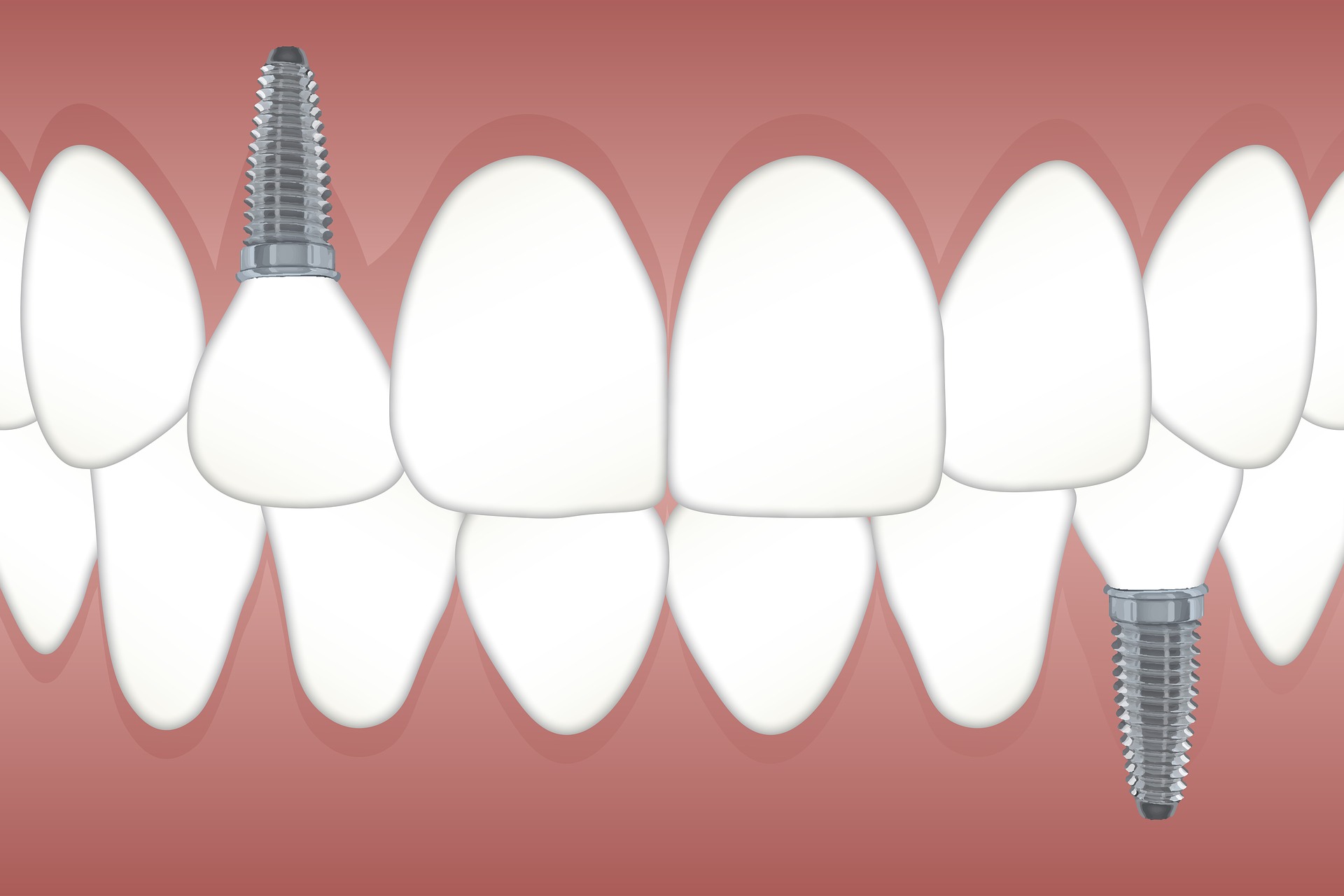 implanty zęba